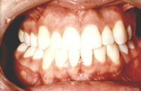 after teeth
