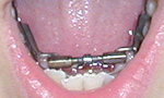 arch expander